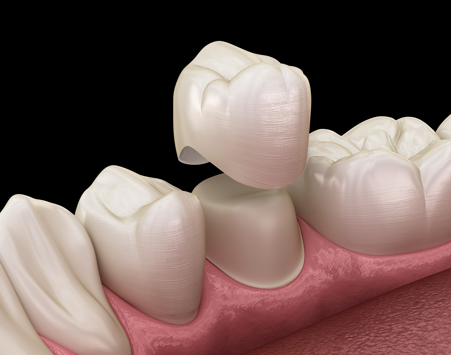 The image shows a 3D rendering of a close-up view of a human tooth with a cavity being filled, set against a black background, which highlights the dental work being performed.