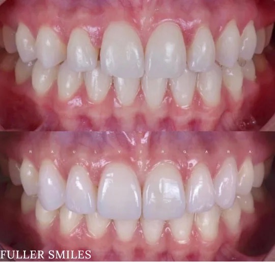 The image displays four photographs of a person s teeth with varying degrees of whiteness, showing before and after results of a teeth whitening treatment, with the text FULLER SMILES at the bottom right corner, suggesting the name of the service or product related to dental care.