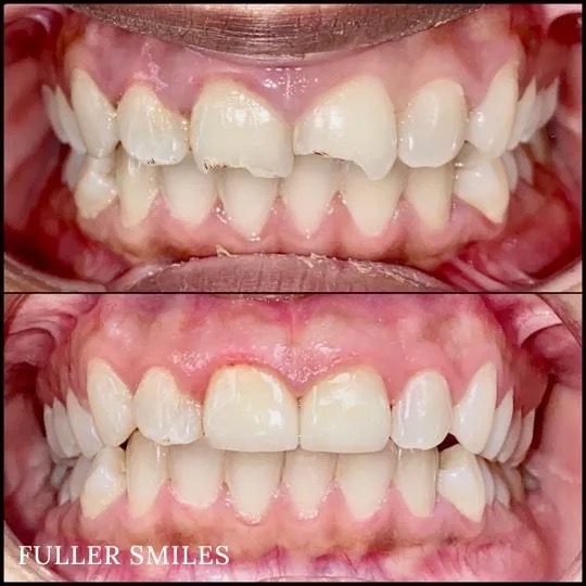 The image displays a before-and-after comparison of teeth whitening treatments, showing a dramatic improvement from yellowed to bright white teeth.