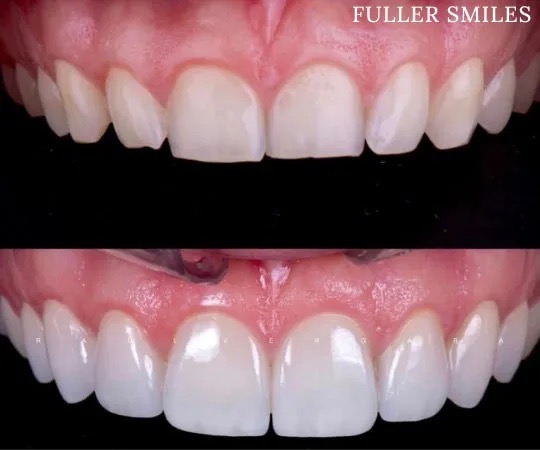 The image shows a close-up view of a person s teeth with a focus on a dental implant, highlighting its appearance and the surrounding natural teeth.