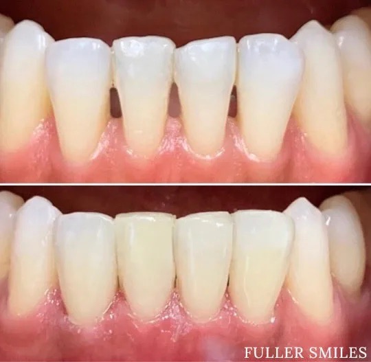 The image shows a close-up view of a person s teeth with a noticeable smile line and yellowing, which appears to be a before and after comparison of dental care services.